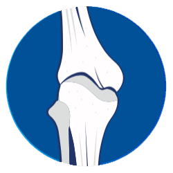 Steroids Bone Demineralization